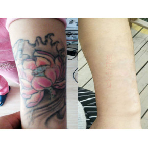 洗纹身还是选择郑氏洗纹身工作室靠谱